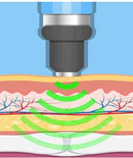 Book an Appointment with Shockwave Provider for Functional (In-person) Office Visits
